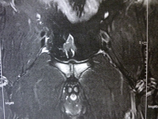 Röntgenbild einer beidseitigen Schambeinentzündung (Ostitis pubis) Röntgenbild: Beidseitige Ostitis pubis