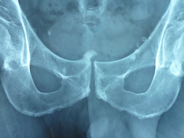 Röntgenbild: Becken mit degenerativen Zeichen