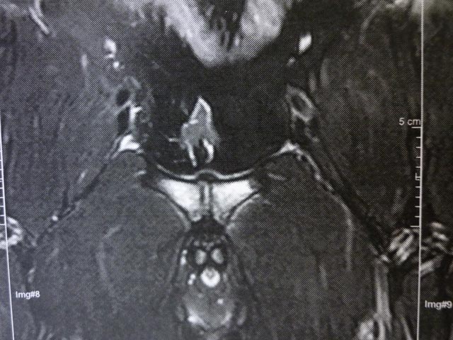 Röntgenbild: Beidseitige Ostitis pubis